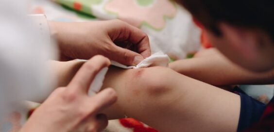 A close-up of a little kid with a knee scrape. Someone sprays something on the cut and holds a tissue near it.